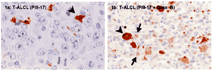 Proteinase inhibitor 9 (human) monoclonal antibody (PI9-17) Immunohistochemistry