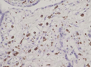CD163 (human) clonal antibody (K20-T) Immunohistochemistry