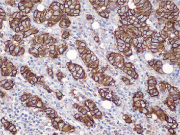 C-erbB-2 (human) clonal antibody (A24-V) Immunohistochemistry