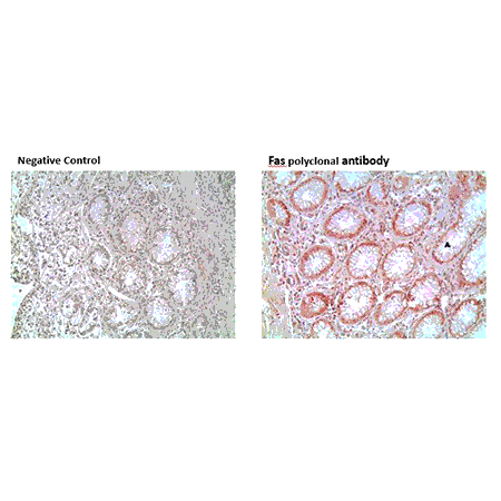 Fas polyclonal antibody Immunohistochemistry colon tumor