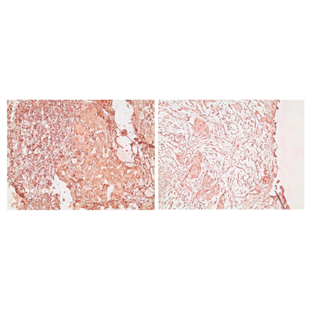 Estrogen receptor alpha monoclonal antibody (C-542) Immunohistochemistry