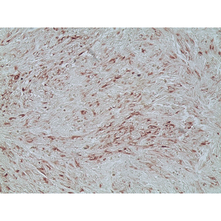Melanoma marker (human) monoclonal antibody (HMB45) (Ready-to-Use) Immunohistochemistry