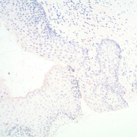 PATHO-GENE HPV 16-18-31-33-51 Negative Detection Vulva