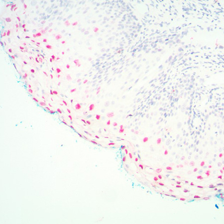 PATHO-GENE HPV 16-18-31-33-51 Positive Detection Cervix