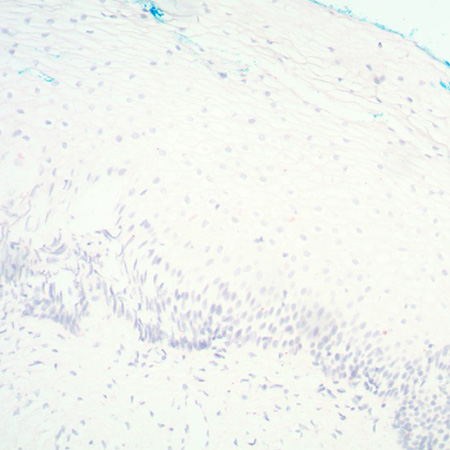 PATHO-GENE HPV 6-11 Negative Detection Cervix