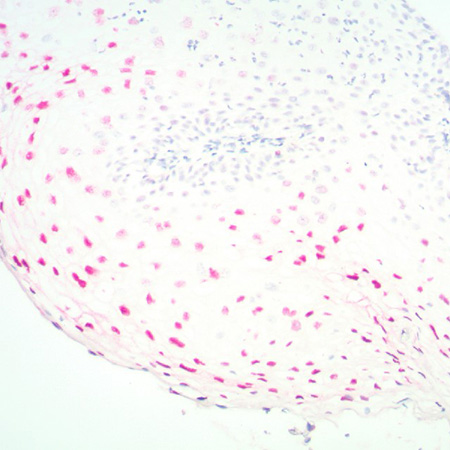 PATHO-GENE HPV 6-11 Positive Detection Vulva