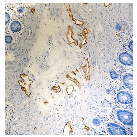 Lymphatic endothelial marker (human) monoclonal antibody (D2-40) Immunohistochemistry
