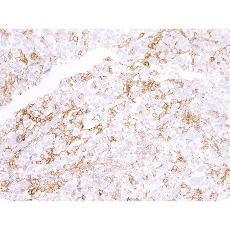 PD-L1 monoclonal antibody Immunohistochemistry lung adenocarcinoma