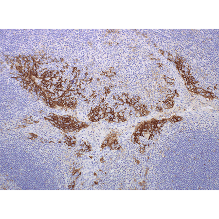 PD-L1 monoclonal antibody Immunohistochemistry tonsil