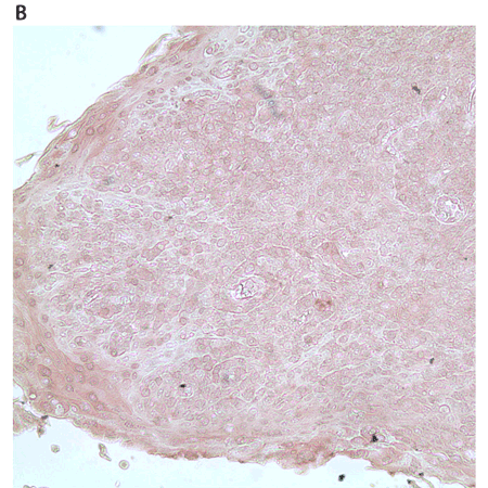 Zap-70 monoclonal antibody (11H40) Immunohistochemistry