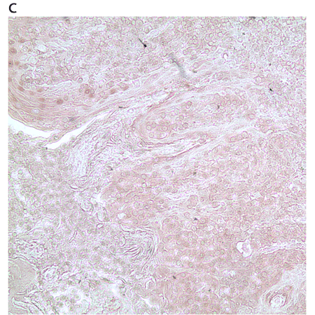 Zap-70 monoclonal antibody (11H40) Immunohistochemistry