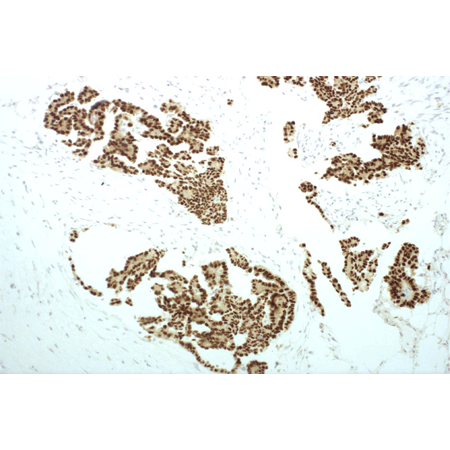 PAX-8 monoclonal antibody Immunohistochemistry on formalin-fixed paraffin sections