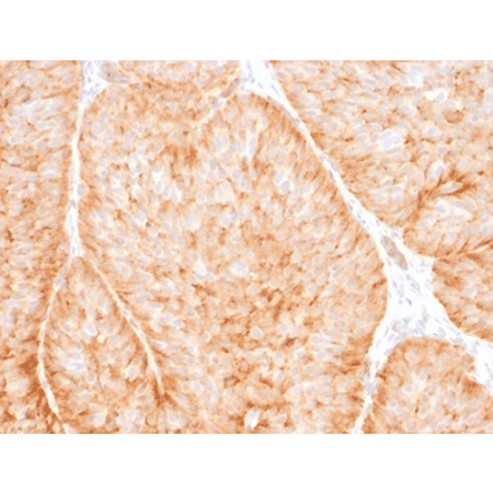 GLUT1 monoclonal antibody (2475) Immunohistochemistry bladder carcinoma