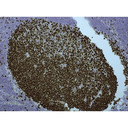 POLYVIEW® PLUS HRP (anti-rabbit) reagent Ki67-POLYVIEW-PLUS-HRP-_anti-rabbit_