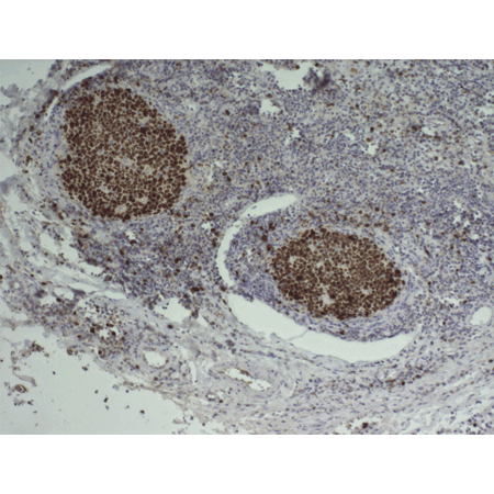 HIGHDEF DAB Chromogen/Substrate Set Immunohistochemistry cancer tonsil tissue 2