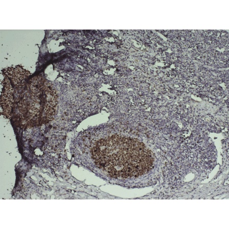 HIGHDEF DAB Chromogen/Substrate Set Immunohistochemistry cancer tonsil tissue