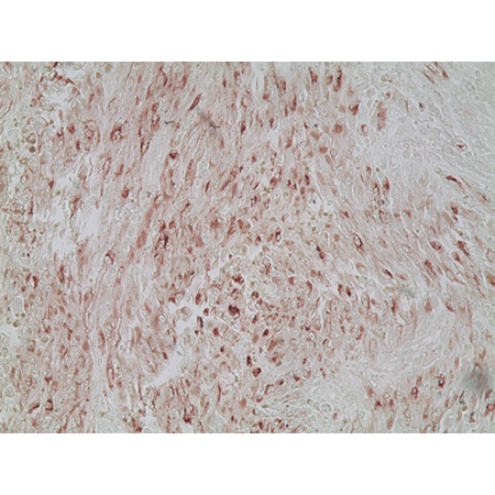 Melanoma marker (human) monoclonal antibody (HMB45) Immunohistochemistry