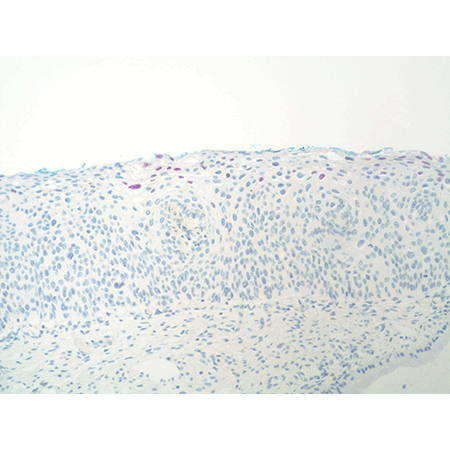 DIGX® HPV type 16/18/31/33/51 probe 10X