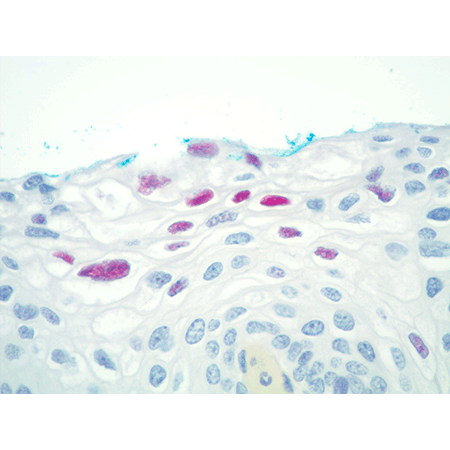 DIGX® HPV type 16/18/31/33/51 probe 40X