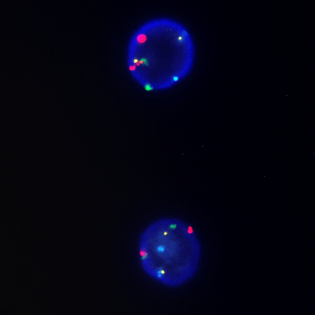 DEEPSEE CDKN2A/CEN3/7/17 Quad Probe Assay FISH urinesamples overnight