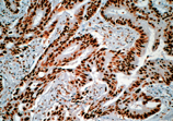 Nucleolin monoclonal antibody (4E2) Immunohistochemistry