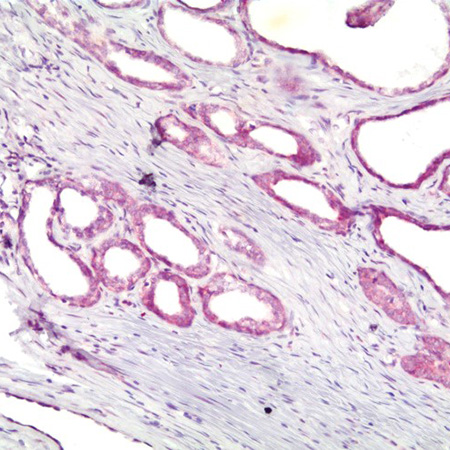 AMPIVIEW EGFR (AS) Dig RNA Probes Set EGFR Detection Prostate Hyperplasia Tissue