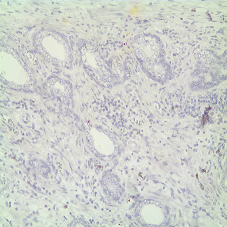 AMPIVIEW NSP Dig RNA Probes in Prostate Tissue