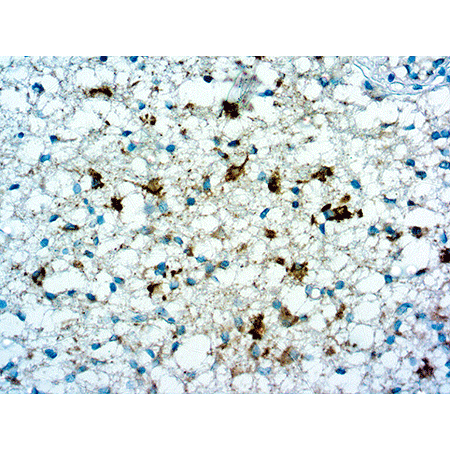 IDH1-R132H monoclonal antibody Immunohistochemistry