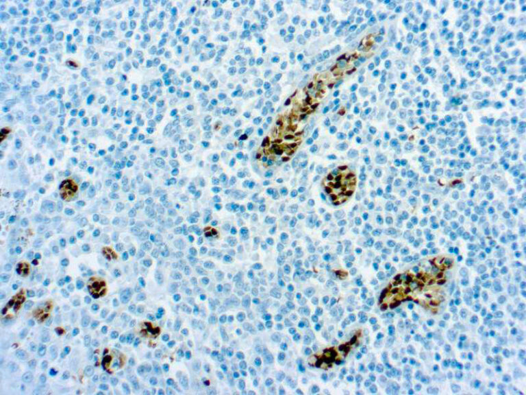 O(6)-Methylguanine-DNA Methyltransferase monoclonal antibody (MT3.1) Immunohistochemistry
