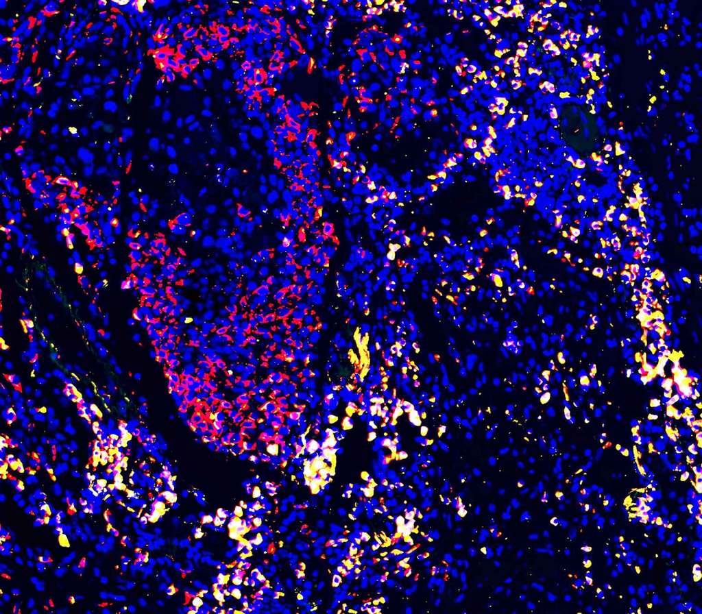 Spatial Biology Enabling Ultimate Multiomics Analysis