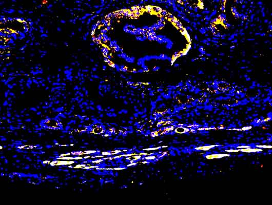 Multiplex ISH, several RNAs detected i  breast cancer tissue.