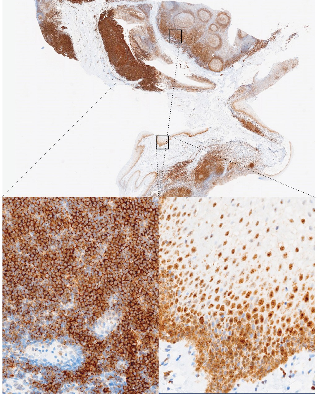 EGFR (brown) was detected in tonsil tissue with AMPIVIEW® EGFR (AS) Dig RNA Probes using Ventana detection reagents on the Ventana Discovery Ultra.